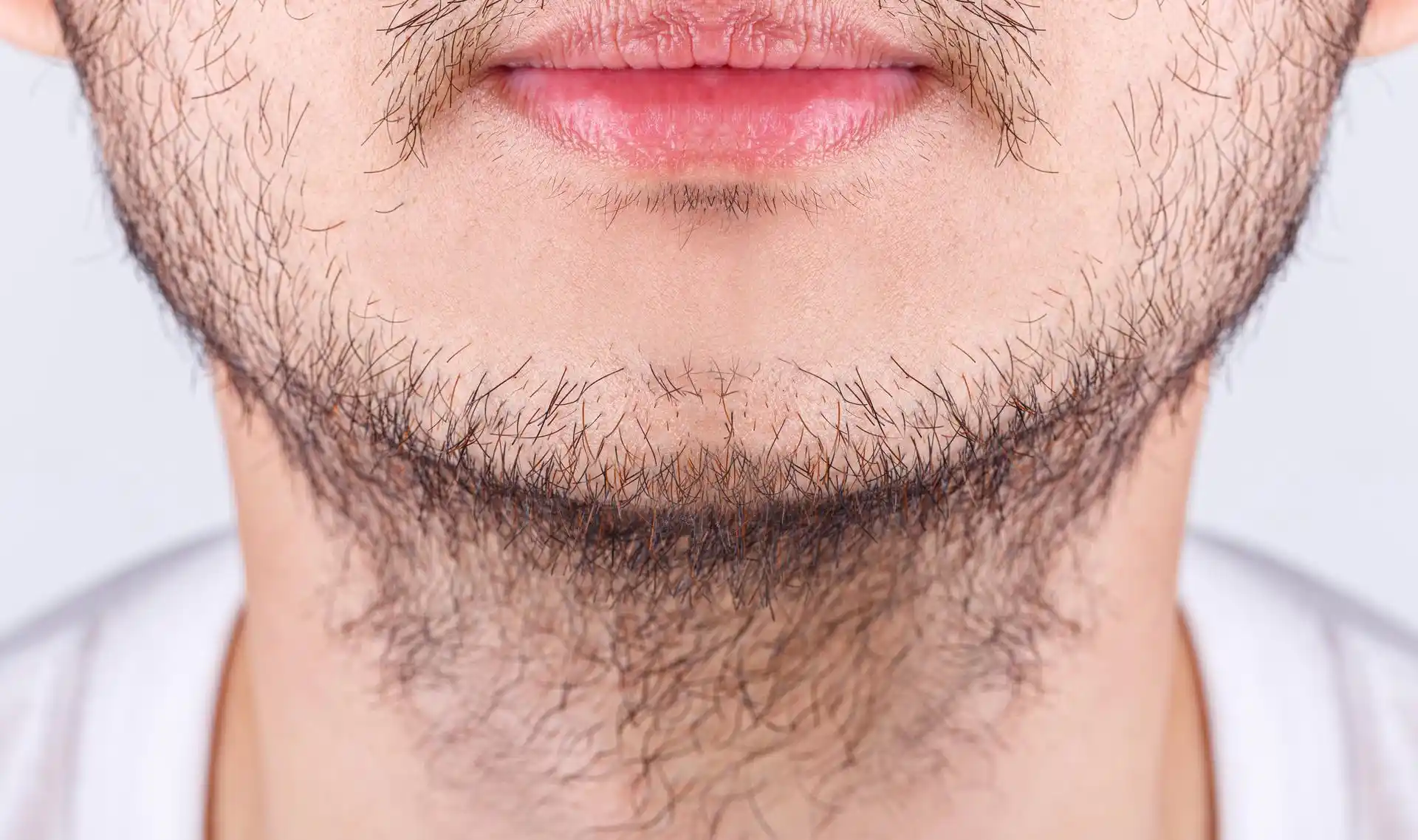Beard Hair Transplant